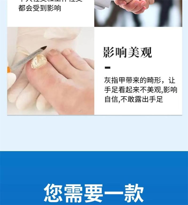 祥医堂 灰指甲专用液体 阿莫罗芬灰甲搽剂乳膏软膏5ml