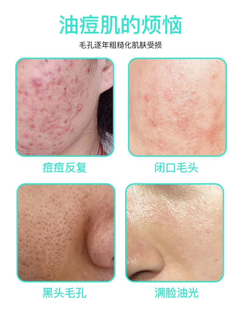 【中國直郵】臻羞 15%壬二酸淨顏凝露100g+水楊酸細緻毛孔霜100g 面部修復神器(日夜組合裝)