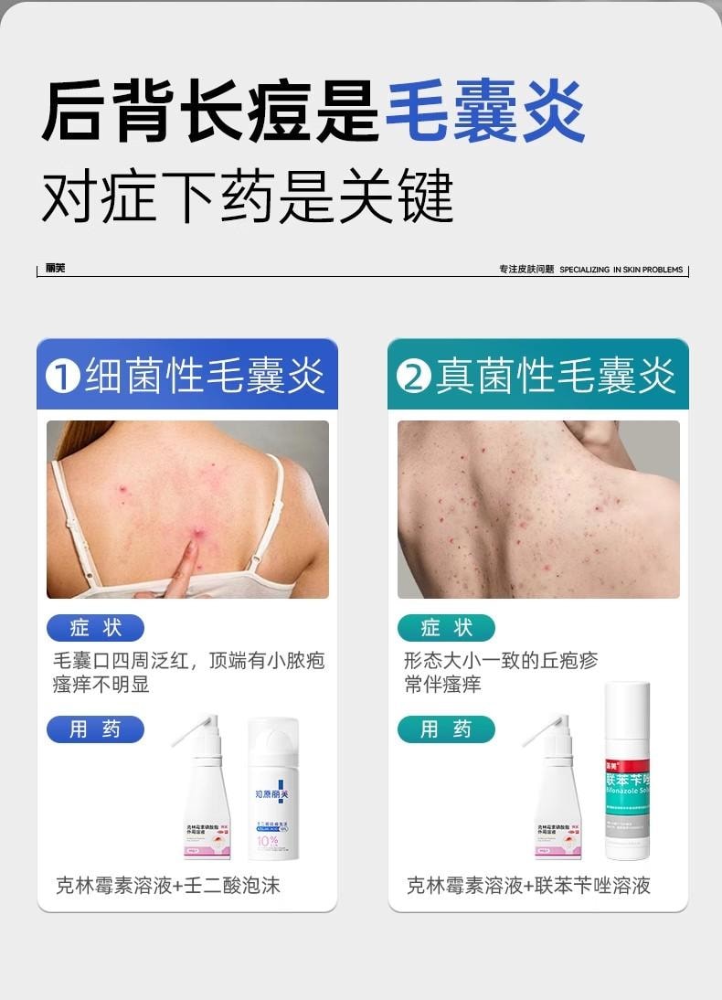 【中國直郵】  麗芙 克林黴素磷酸酯外用溶液 毛囊炎前胸後背祛痘噴霧背部祛痘除蟎 30ml/瓶