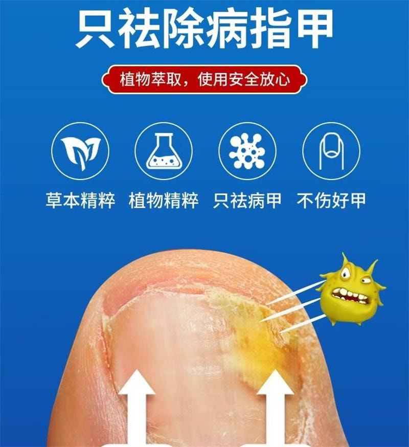 祥医堂 灰指甲专用液体 阿莫罗芬灰甲搽剂乳膏软膏5ml