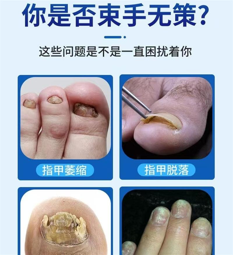 祥医堂 灰指甲专用液体 阿莫罗芬灰甲搽剂乳膏软膏5ml