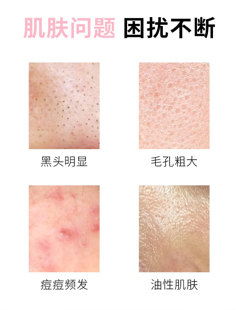 【中國直郵】臻羞 15%壬二酸淨顏凝露100g+水楊酸細緻毛孔霜100g 面部修復神器(日夜組合裝)