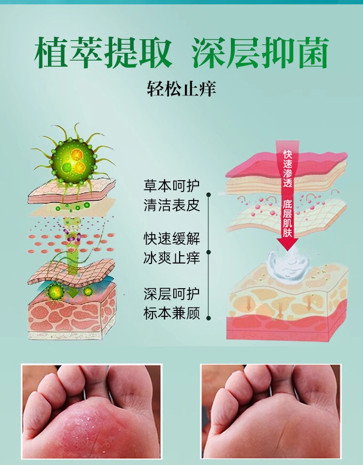 雲南本草 腳氣除脫皮殺菌噴霧 去爛腳丫止癢膏臭腳出汗腳癢水泡 50ml/瓶
