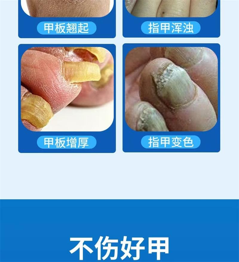 祥医堂 灰指甲专用液体 阿莫罗芬灰甲搽剂乳膏软膏5ml