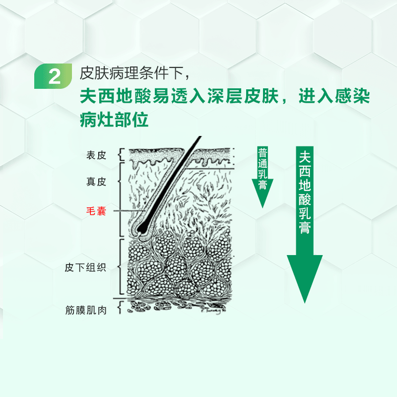【中國直郵】奧絡  夫西地酸乳膏祛痘2%軟膏甲溝炎慢性溼疹皮膚病   10g/支