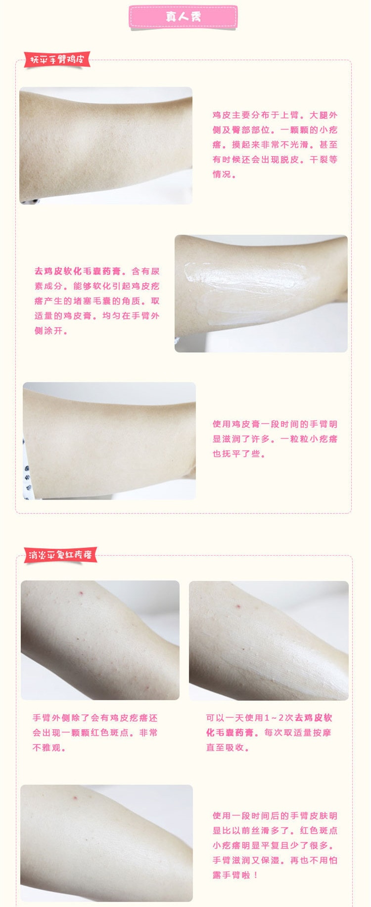 【日本直郵】 小林製藥 去雞皮去角質軟化毛囊膏30g裝