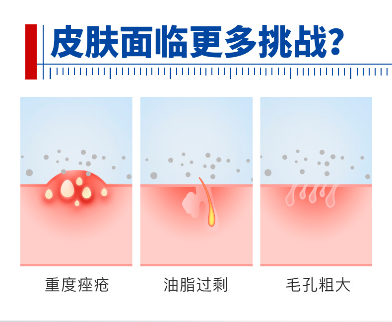 【中国直邮】 芙清 祛痘修复黑膜医用面膜 淡化痘印痤疮脓包痘痘炎症 1盒5片