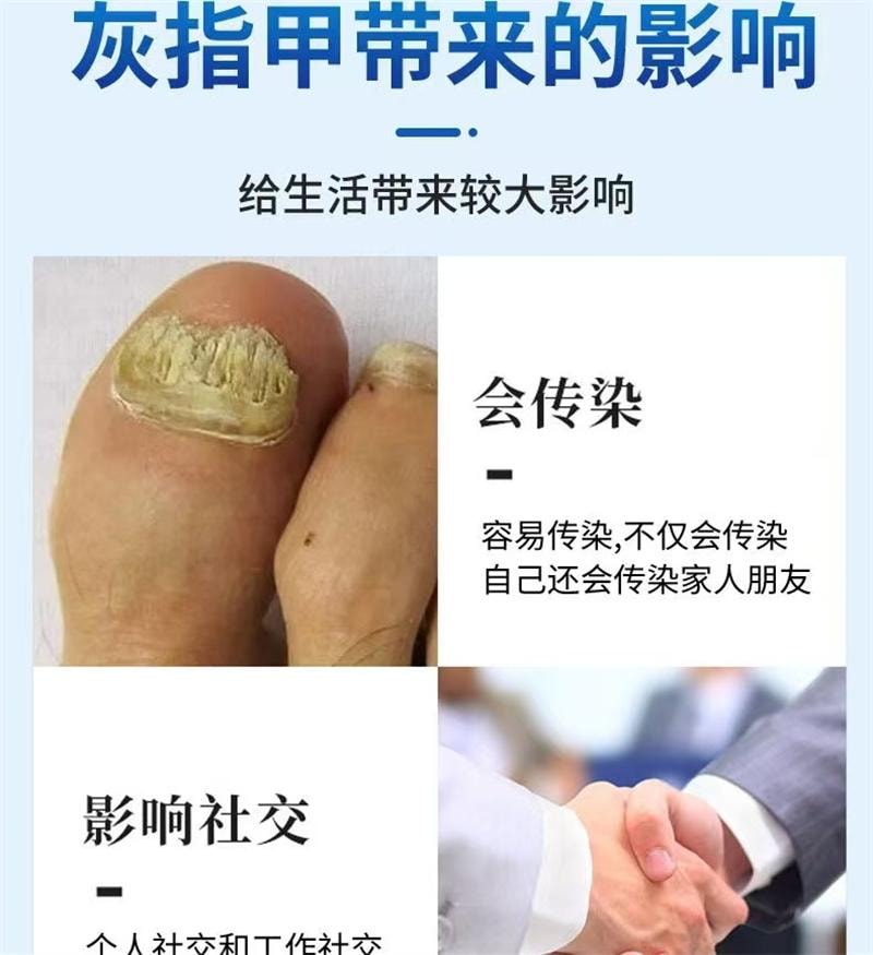 祥医堂 灰指甲专用液体 阿莫罗芬灰甲搽剂乳膏软膏5ml