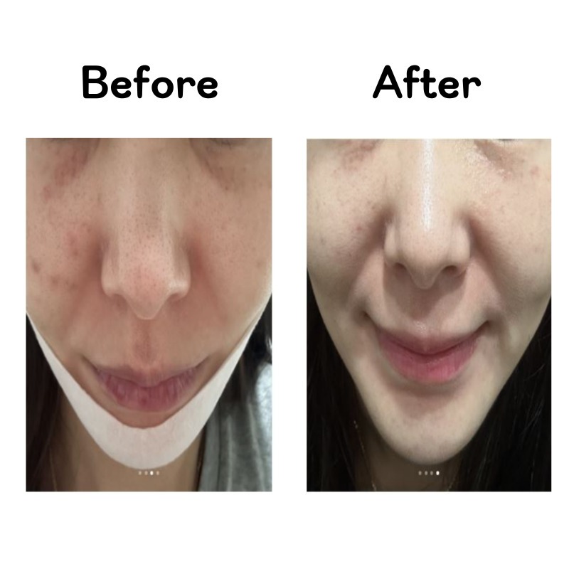 glutathione whitening Get Dr.Esther New! Glutathione Direct 5X Skin Whitening (325mg x 30 sheets)  (9.75g) Delivered