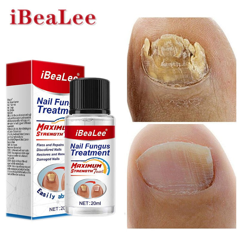 iBeaLee Onychomycosis Antibacterial Liquid Onychomycosis Special Medicine 1 count