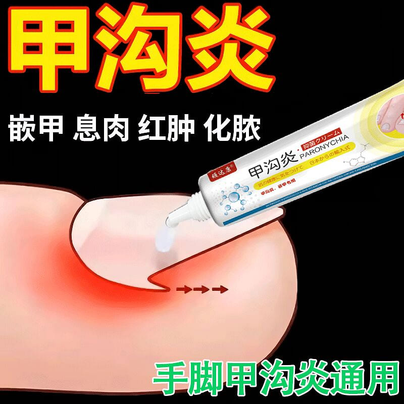 Paronychia, anti-inflammatory and analgesic drugs 15 g